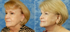 Face Lift & Lower Blepharoplasty